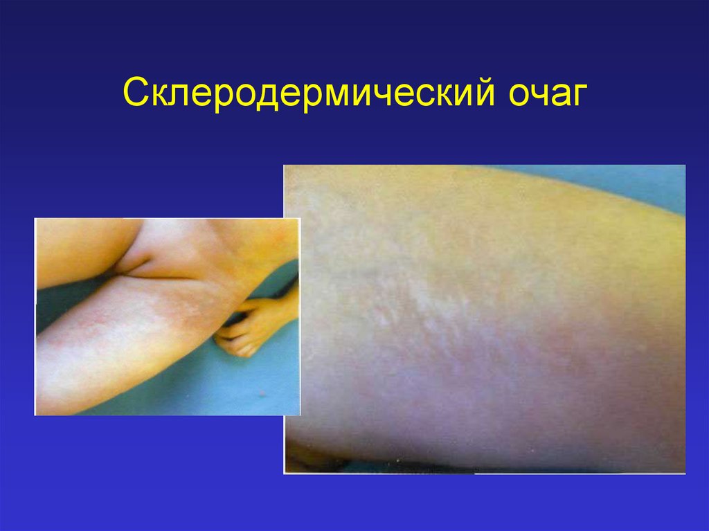 Склеродермический очаг