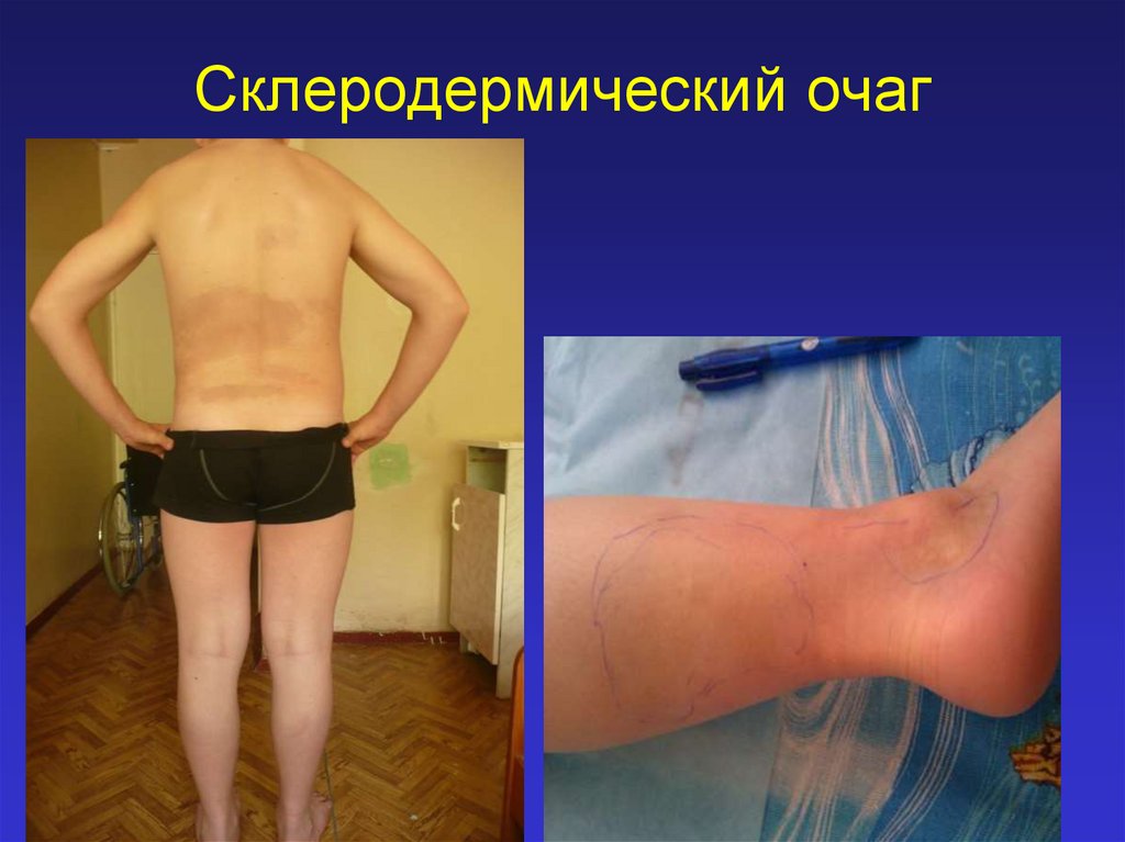 Склеродермический очаг