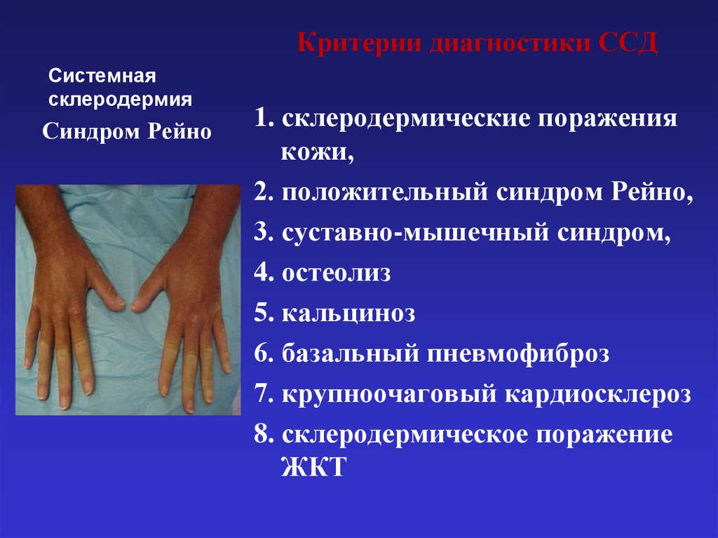 Системная склеродермия