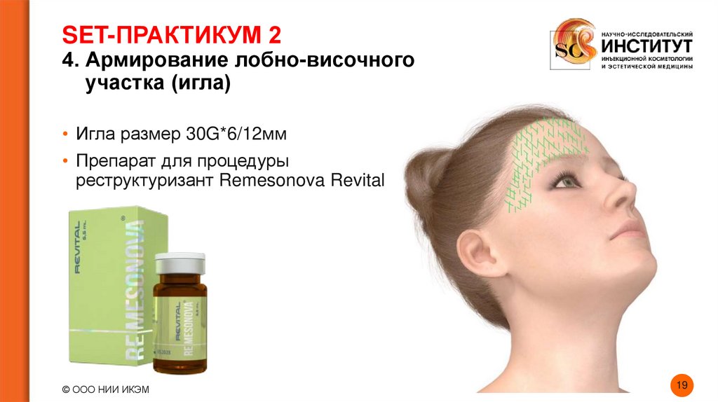 SET-ПРАКТИКУМ 2 4. Армирование лобно-височного участка (игла)