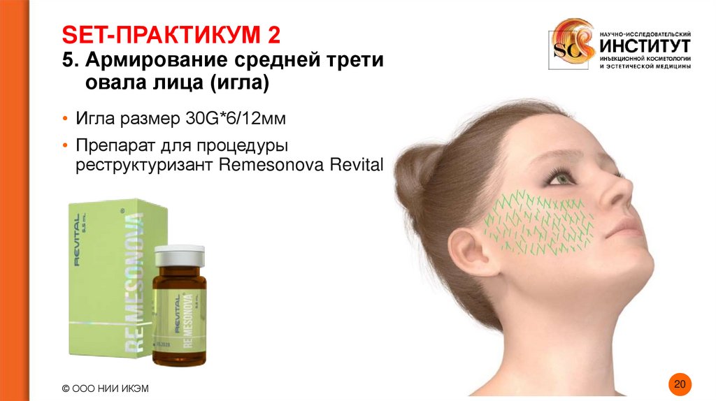 SET-ПРАКТИКУМ 2 5. Армирование средней трети овала лица (игла)