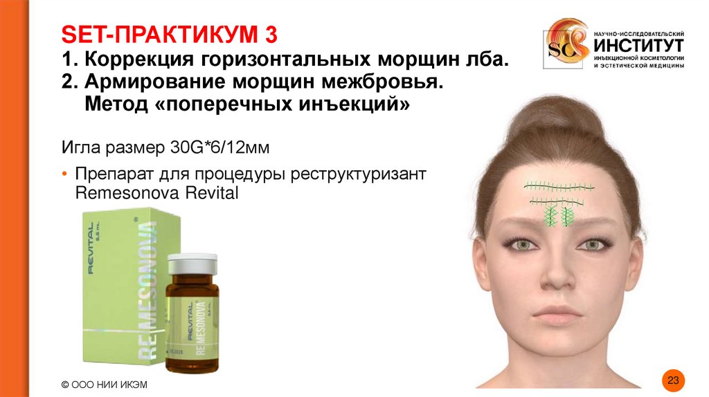 SET-ПРАКТИКУМ 3 1. Коррекция горизонтальных морщин лба. 2. Армирование морщин межбровья. Метод «поперечных инъекций»