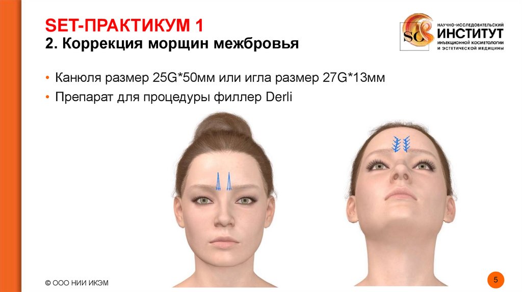 SET-ПРАКТИКУМ 1 2. Коррекция морщин межбровья