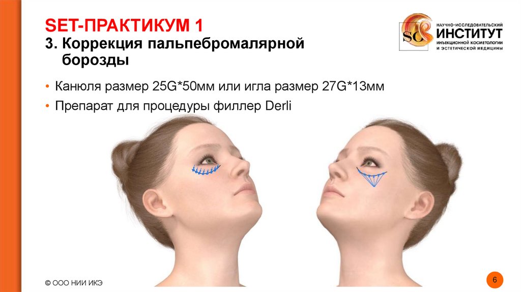 SET-ПРАКТИКУМ 1 3. Коррекция пальпебромалярной борозды