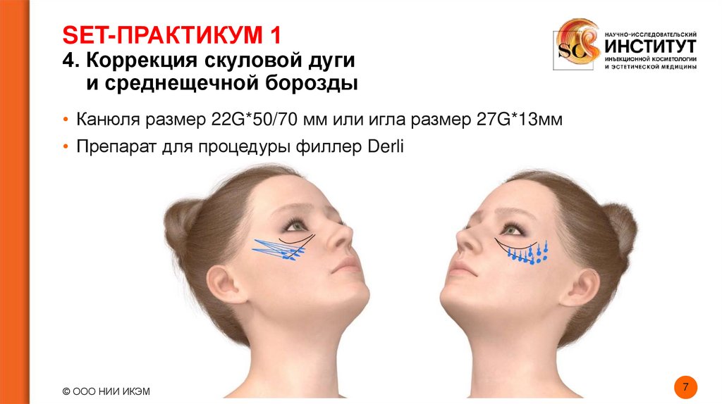 SET-ПРАКТИКУМ 1 4. Коррекция скуловой дуги и среднещечной борозды