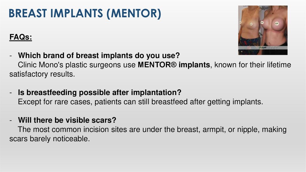 Breast Implants (Mentor)