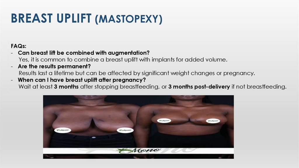 Breast Uplıft (Mastopexy)
