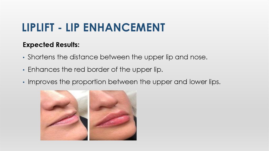 LIplIft - LIp Enhancement