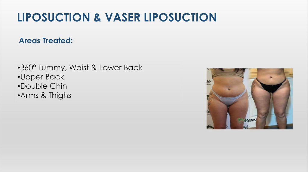 LIposuctIon & VASER LIposuctIon