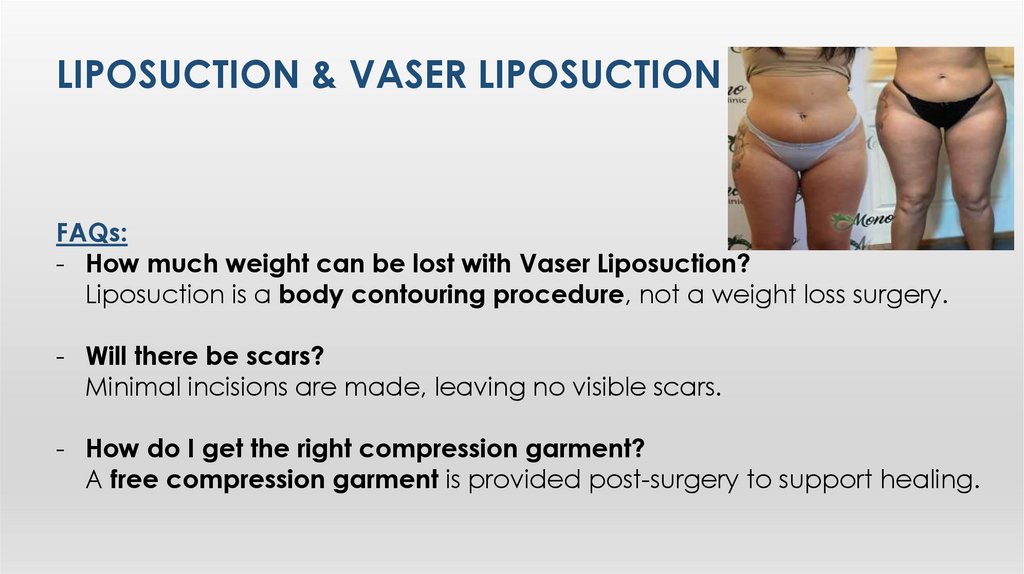 LIposuctIon & VASER LIposuctIon