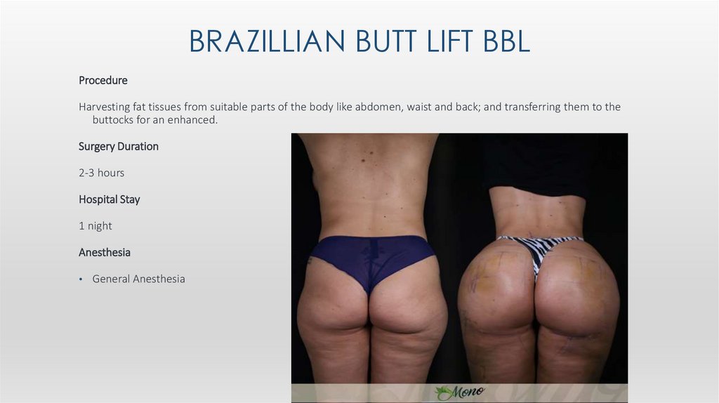 Brazıllıan Butt Lıft bbl