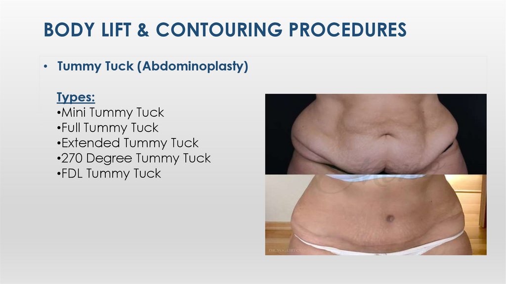 Body LIft & ContourIng Procedures