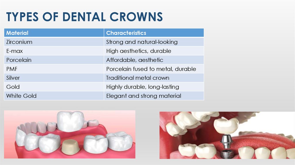 Types of Dental Crowns