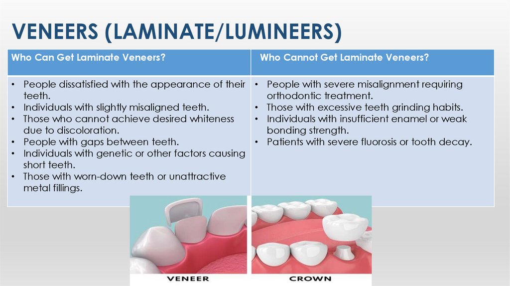 Veneers (LamInate/LumIneers)