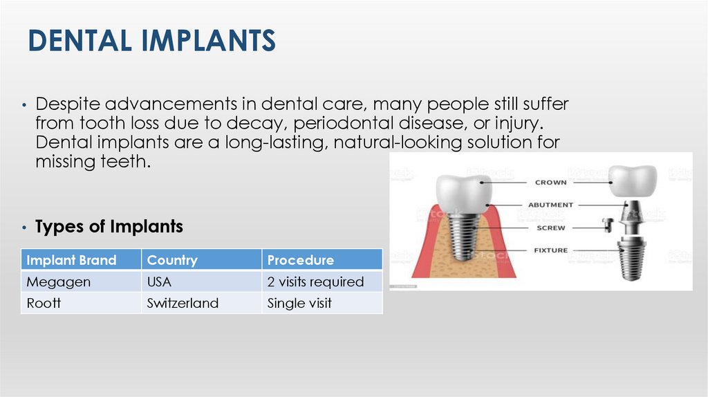 Dental Implants
