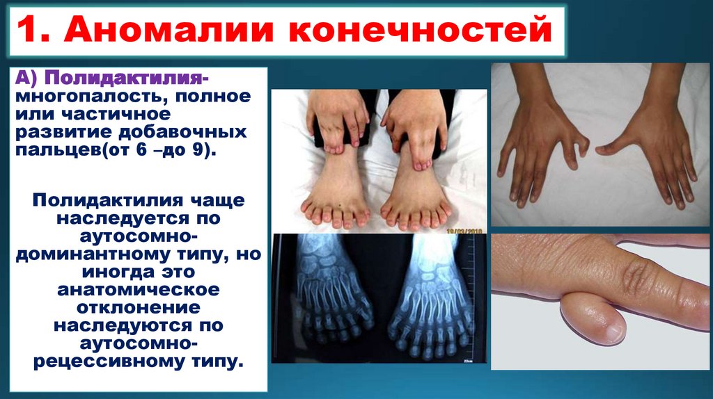 1. Аномалии конечностей
