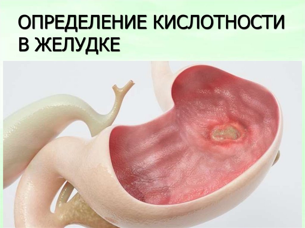 ОПРЕДЕЛЕНИЕ КИСЛОТНОСТИ В ЖЕЛУДКЕ