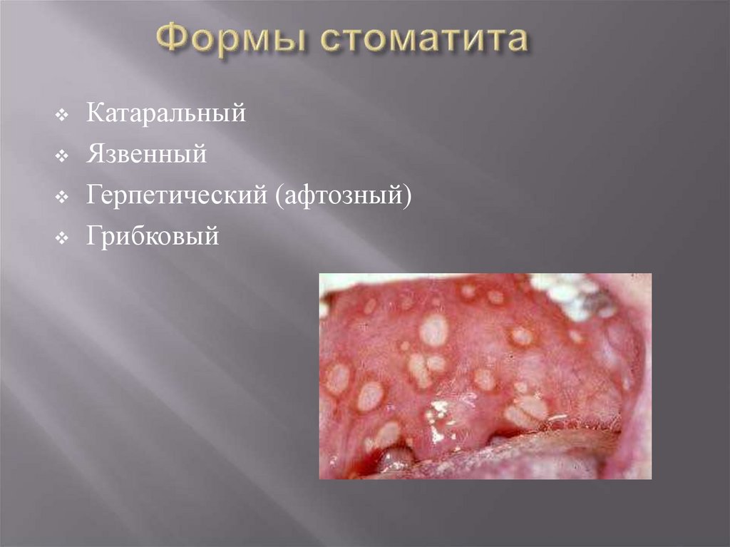 Формы стоматита