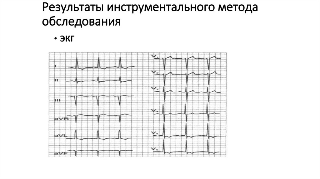 Результаты инструментального метода обследования