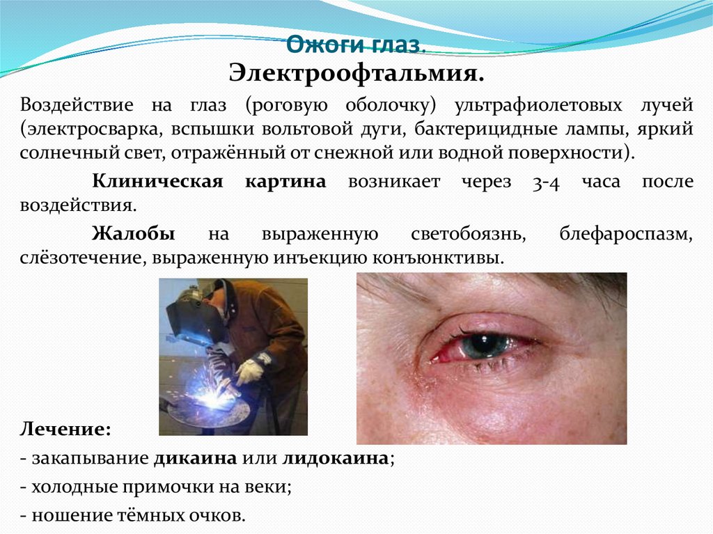 Ожоги глаз.