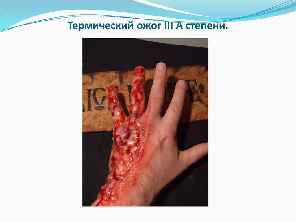 Термический ожог III А степени.