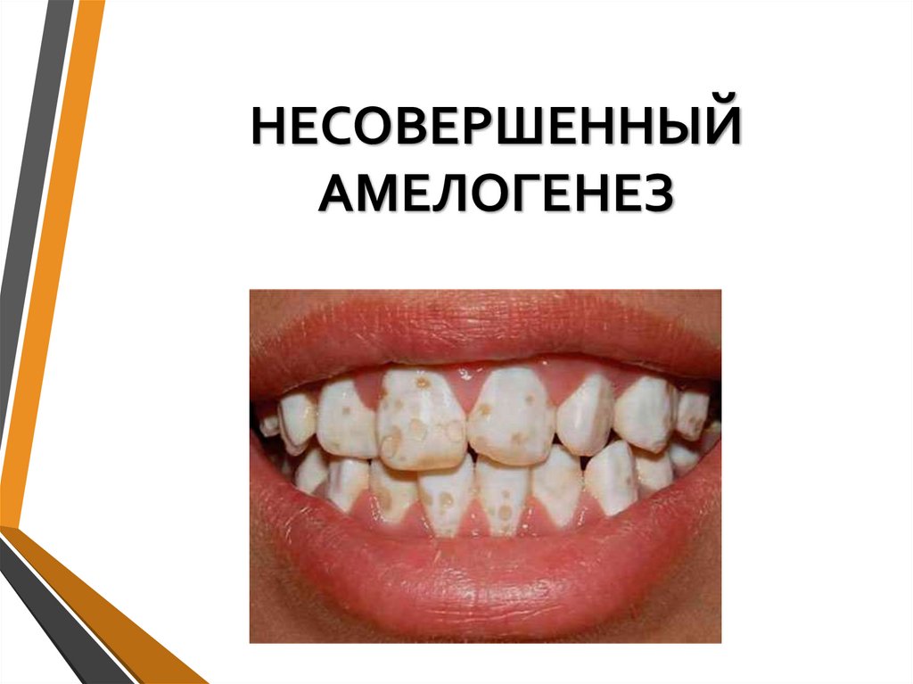 НЕСОВЕРШЕННЫЙ АМЕЛОГЕНЕЗ