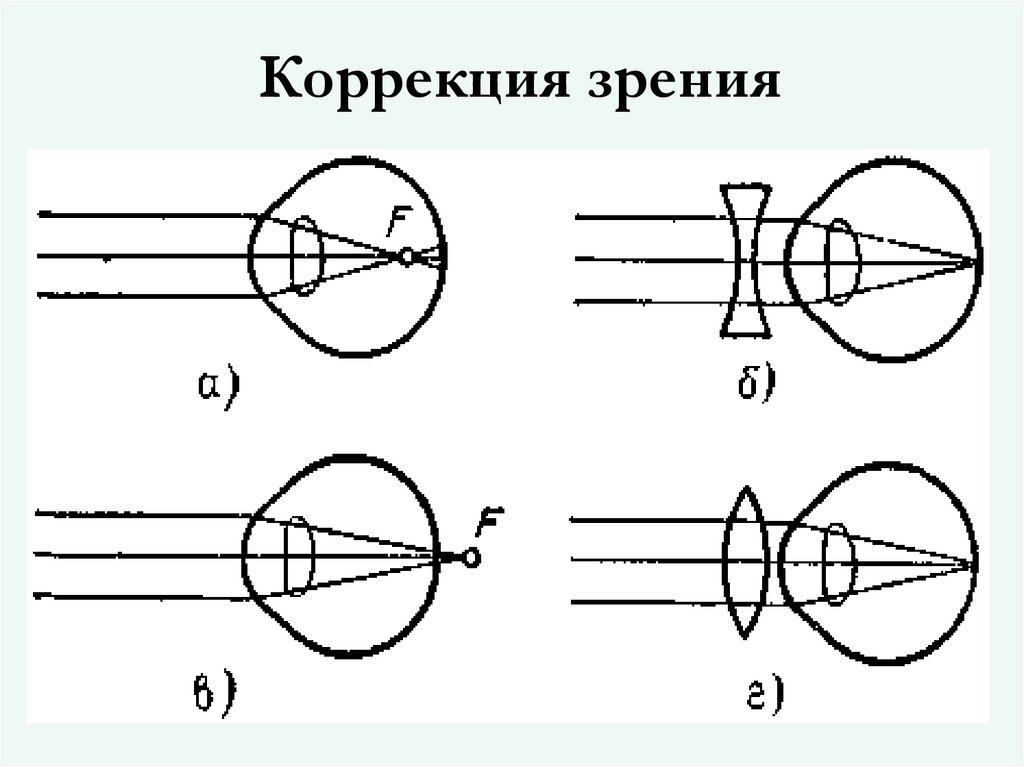Коррекция зрения