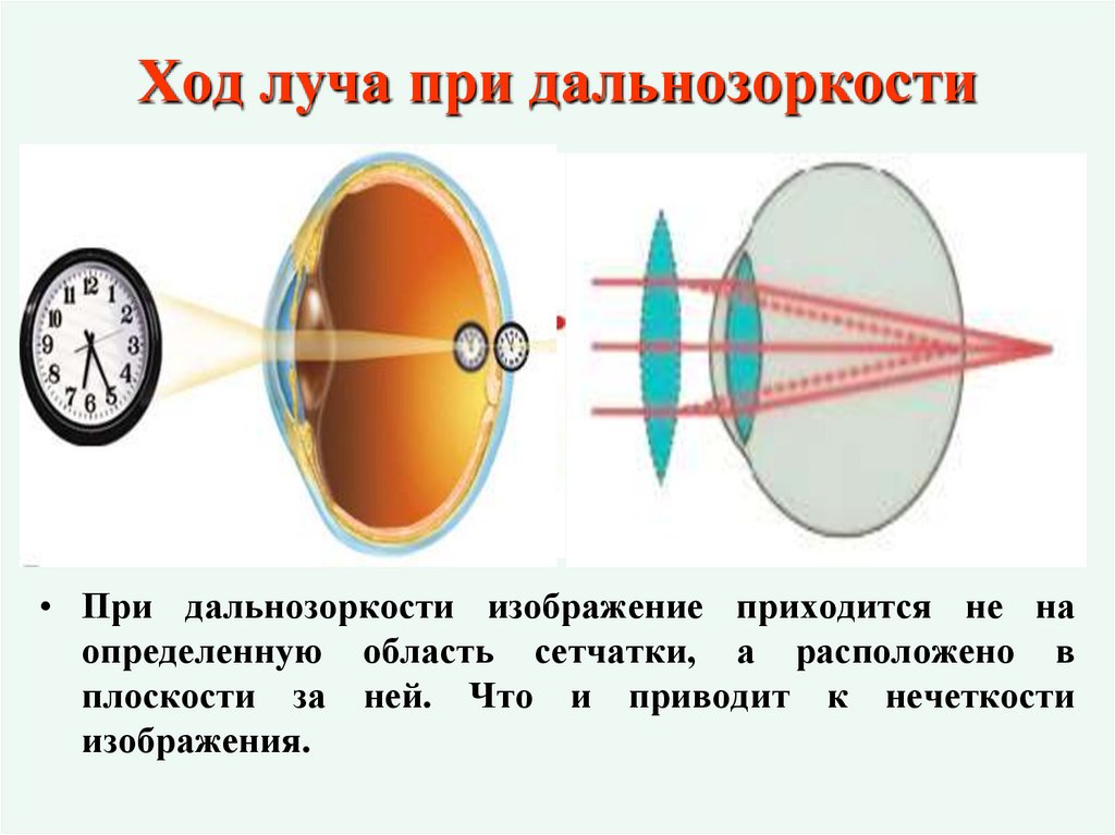 Ход луча при дальнозоркости