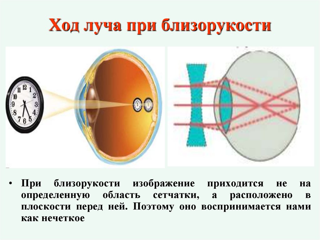 Ход луча при близорукости