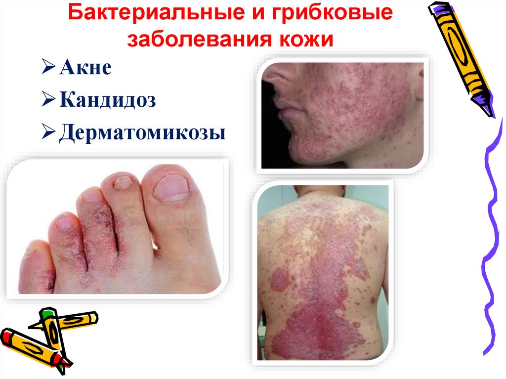 Бактериальные и грибковые заболевания кожи