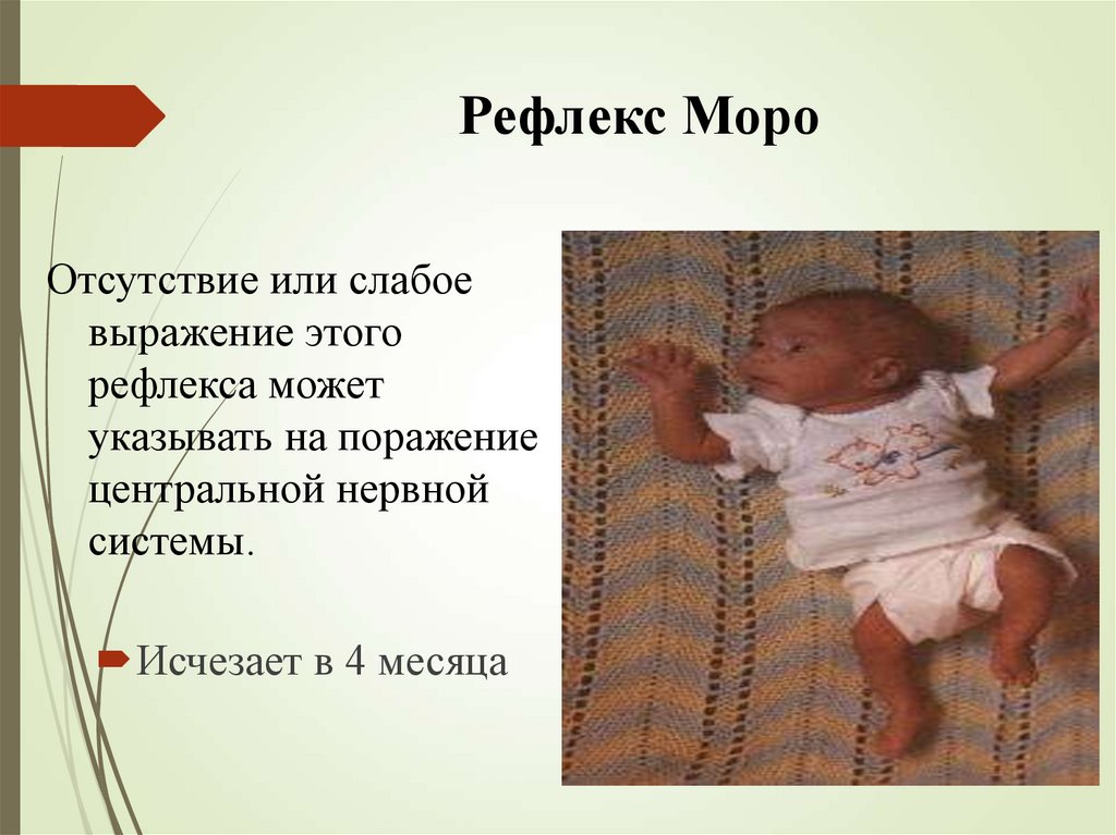 Рефлекс Моро