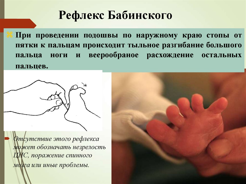 Рефлекс Бабинского