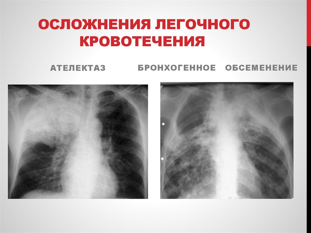 Осложнения легочного кровотечения
