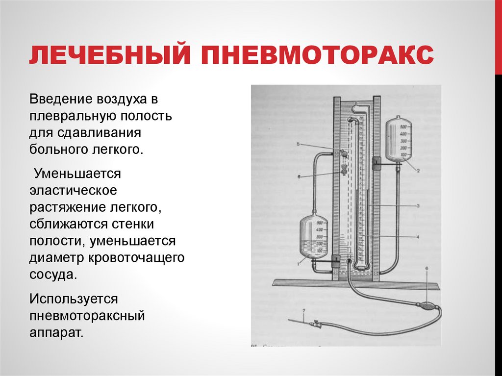 Лечебный пневмоторакс