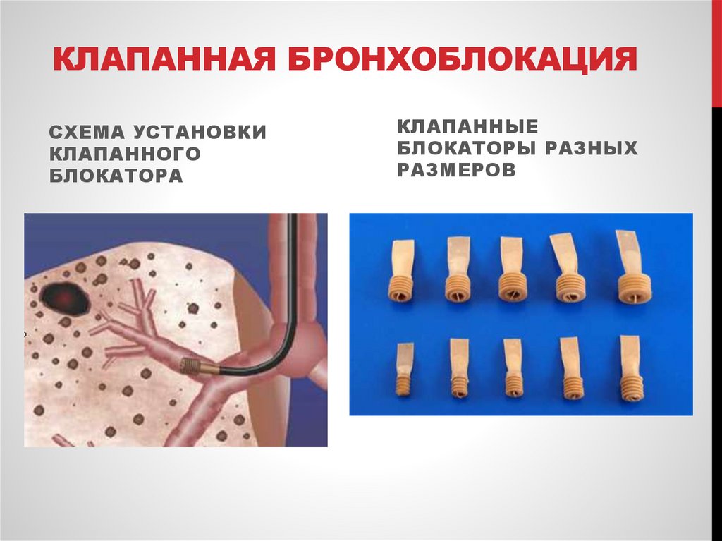 Клапанная бронхоблокация