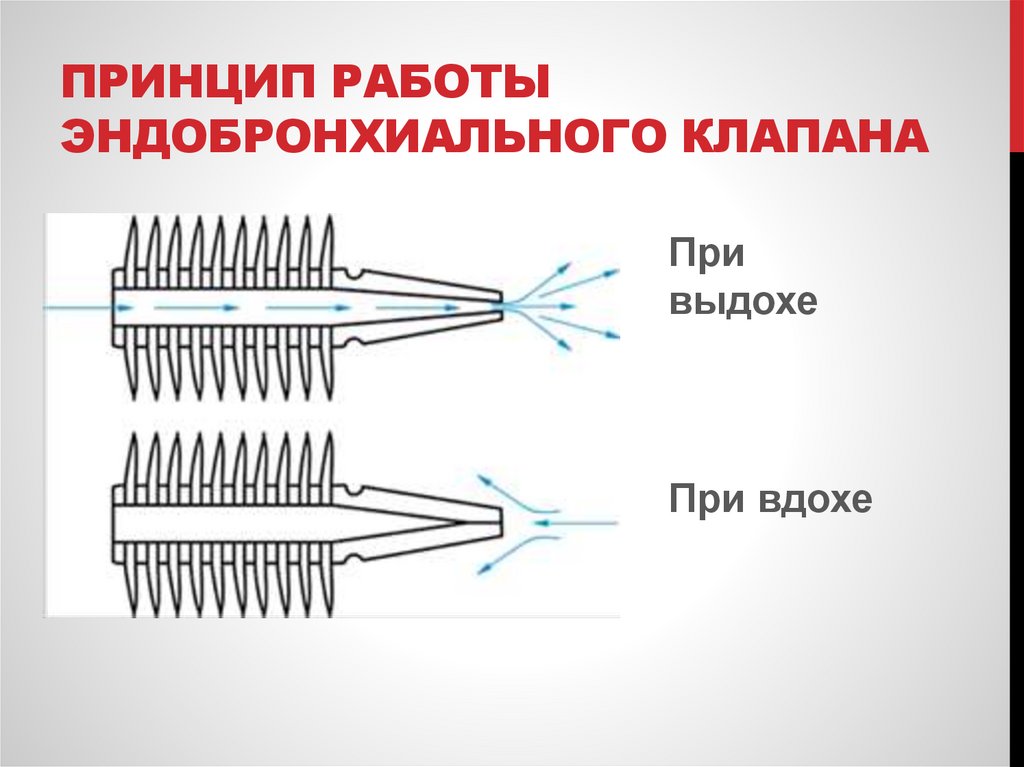 Принцип работы эндобронхиального клапана