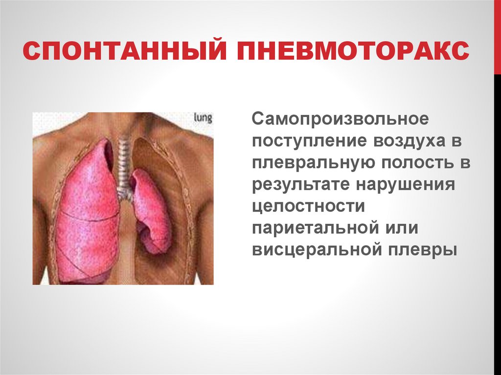 Спонтанный пневмоторакс