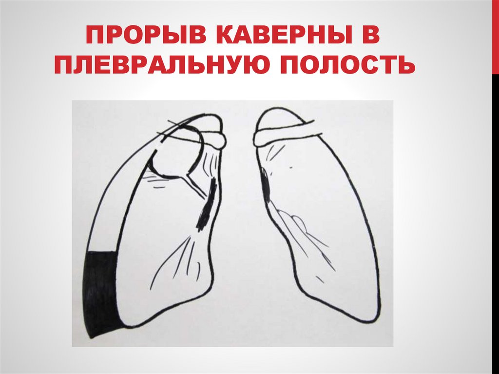 Прорыв каверны в плевральную полость