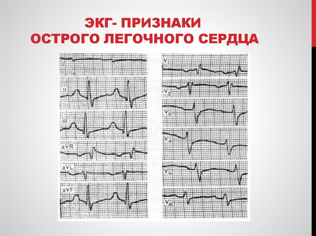 ЭКГ- признаки Острого легочного сердца