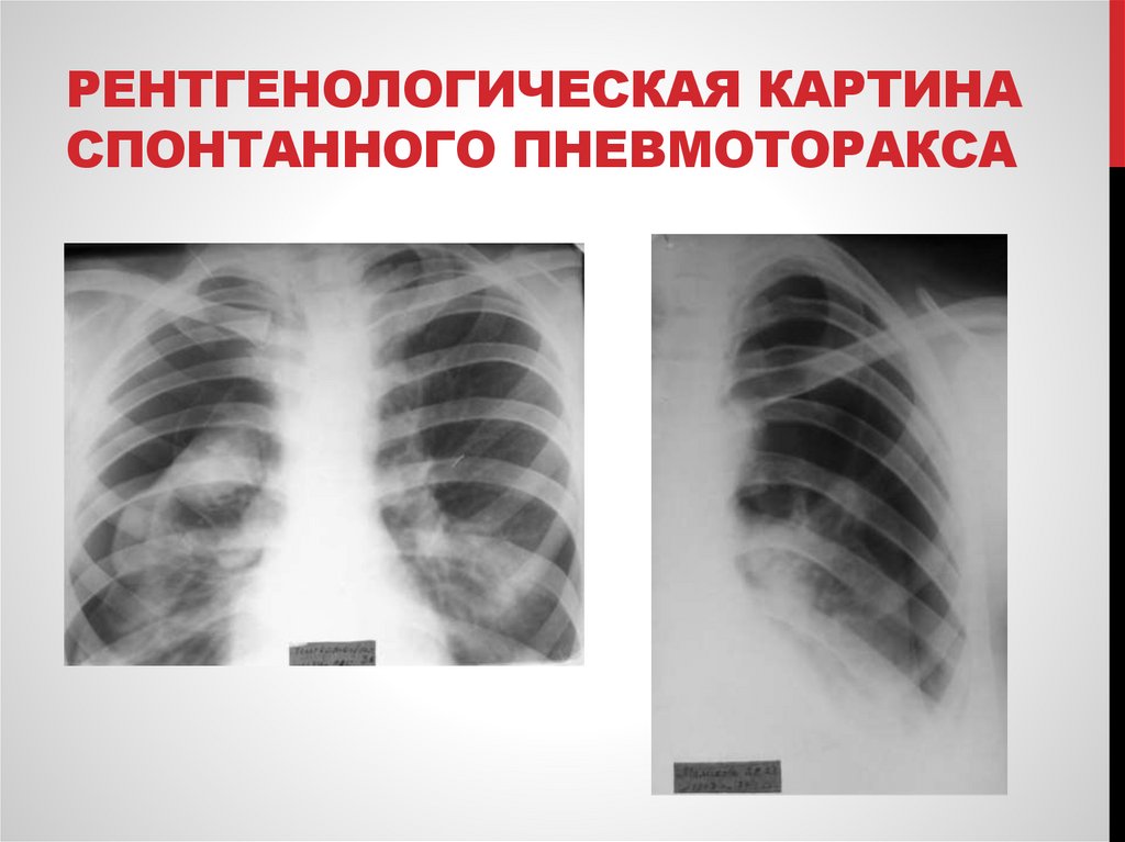 Рентгенологическая картина спонтанного пневмоторакса