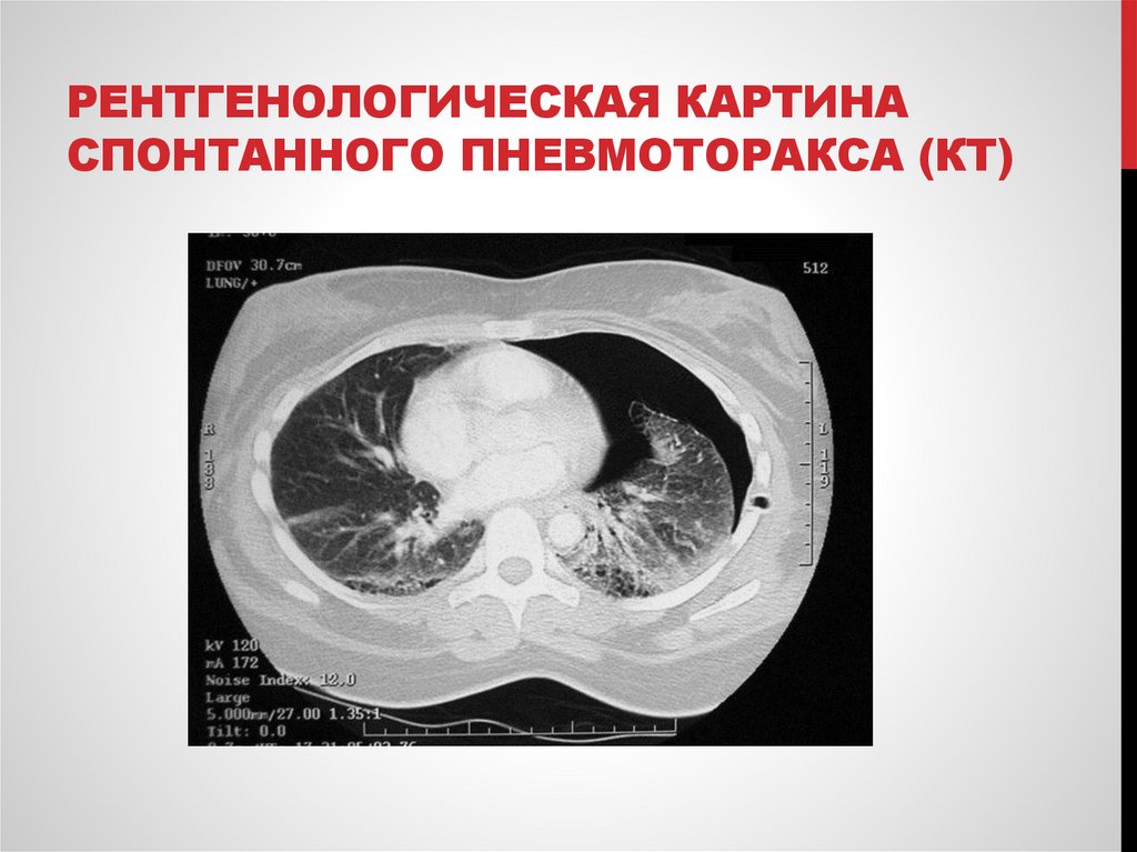 Рентгенологическая картина спонтанного пневмоторакса (КТ)
