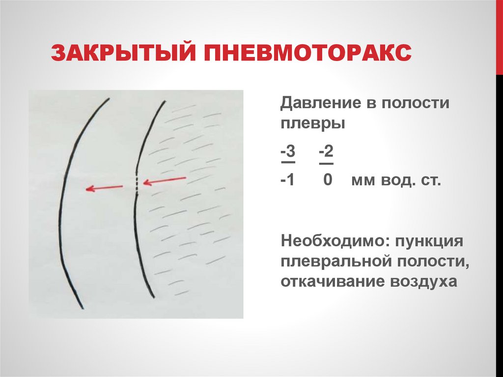 Закрытый пневмоторакс