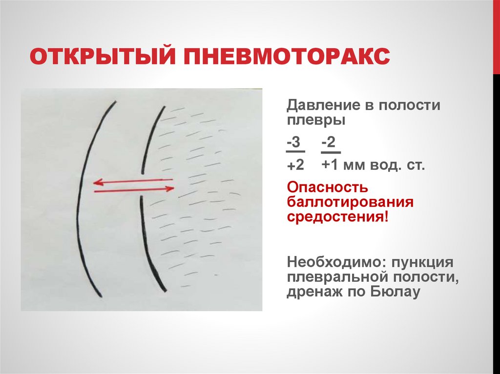 Открытый пневмоторакс