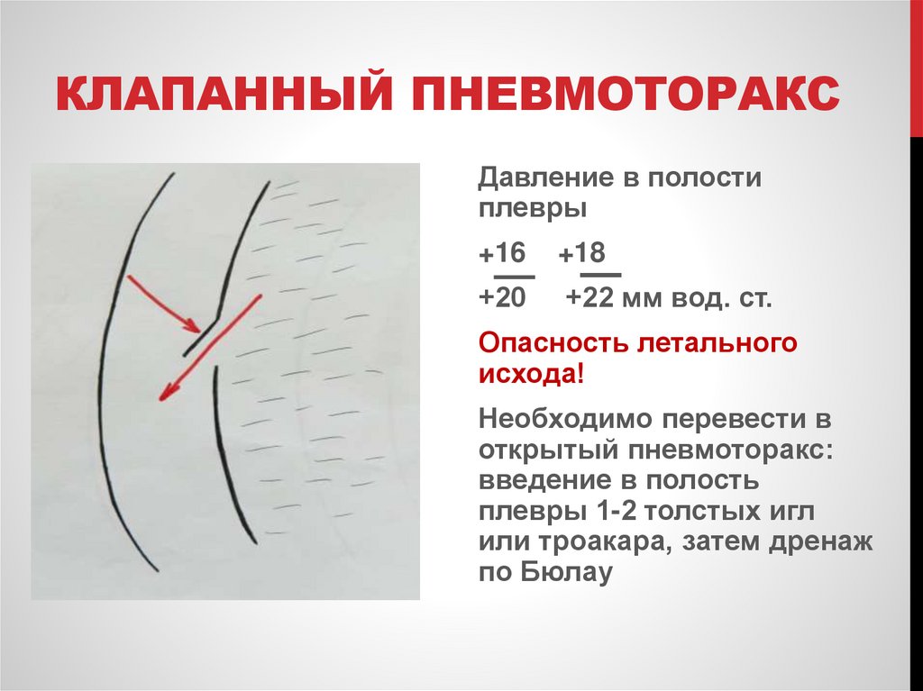 Клапанный пневмоторакс