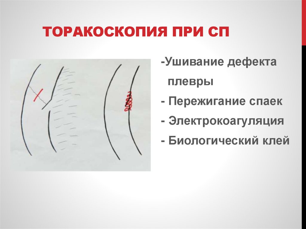 Торакоскопия при СП