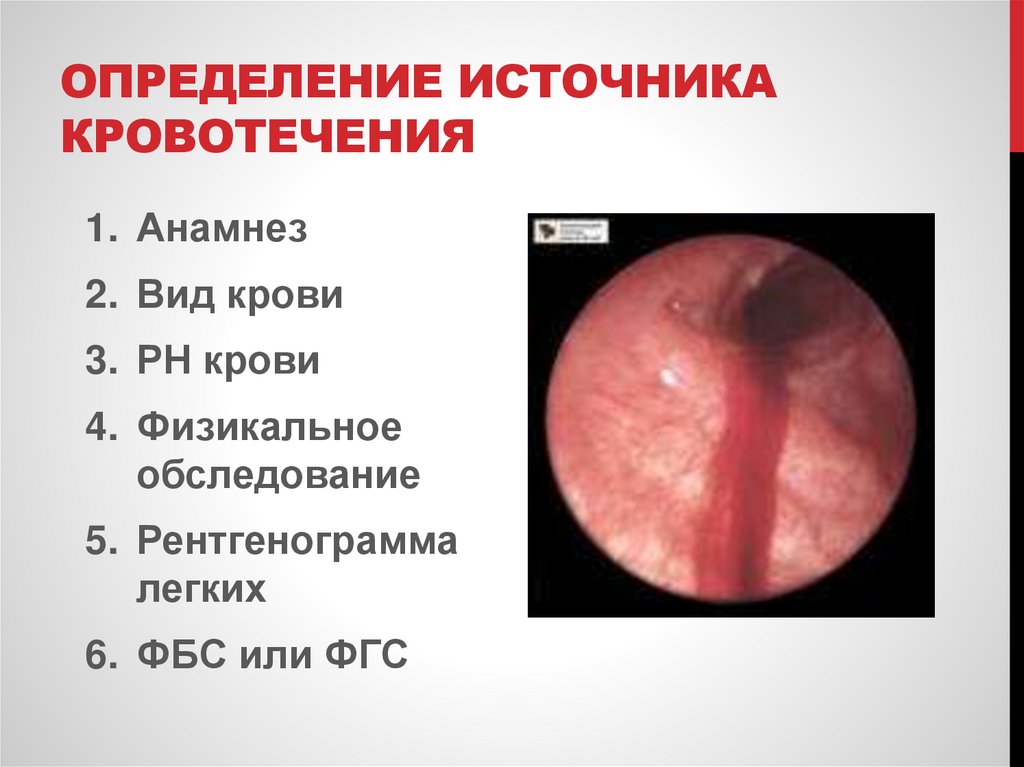 Определение источника кровотечения