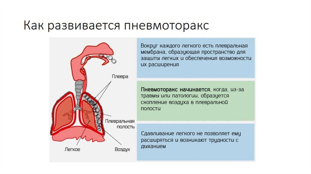 Как развивается пневмоторакс