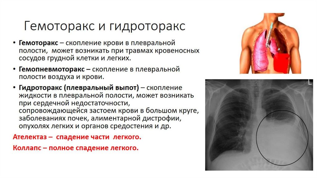 Гемоторакс и гидроторакс