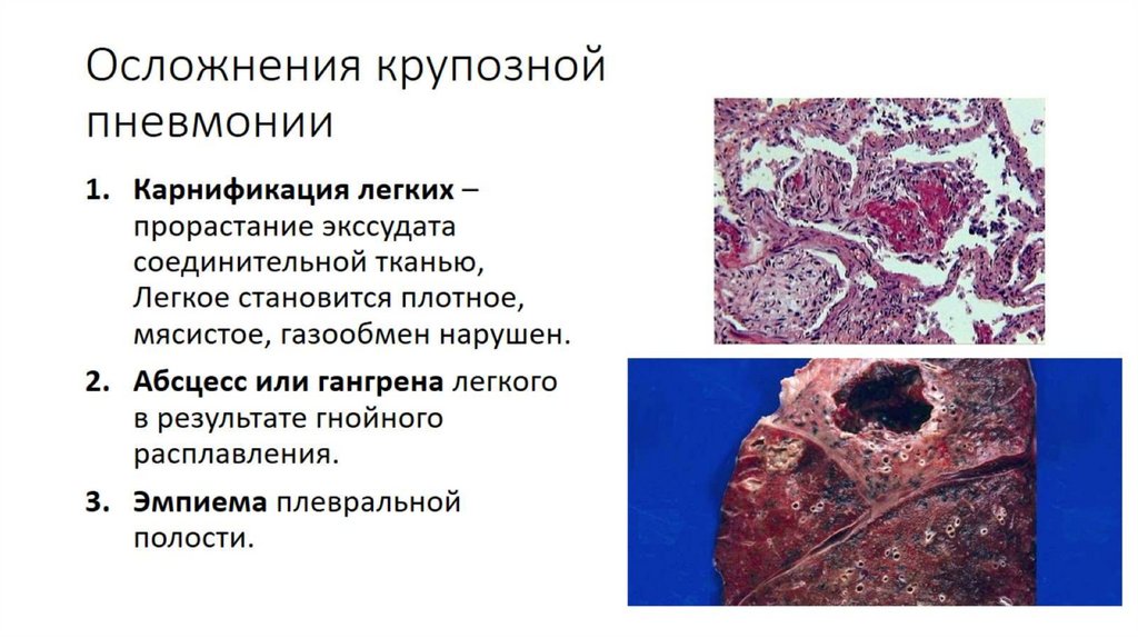 Осложнения крупозной пневмонии