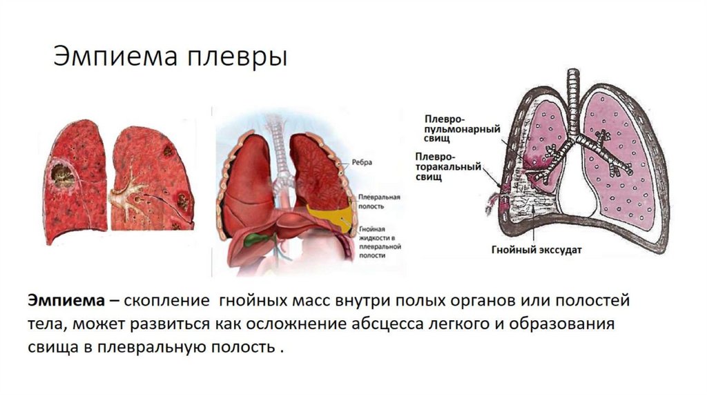 Эмпиема плевры